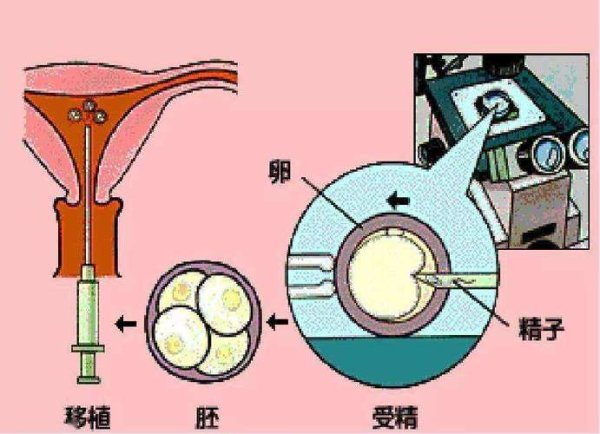 人工助孕方案解析助孕技术优势